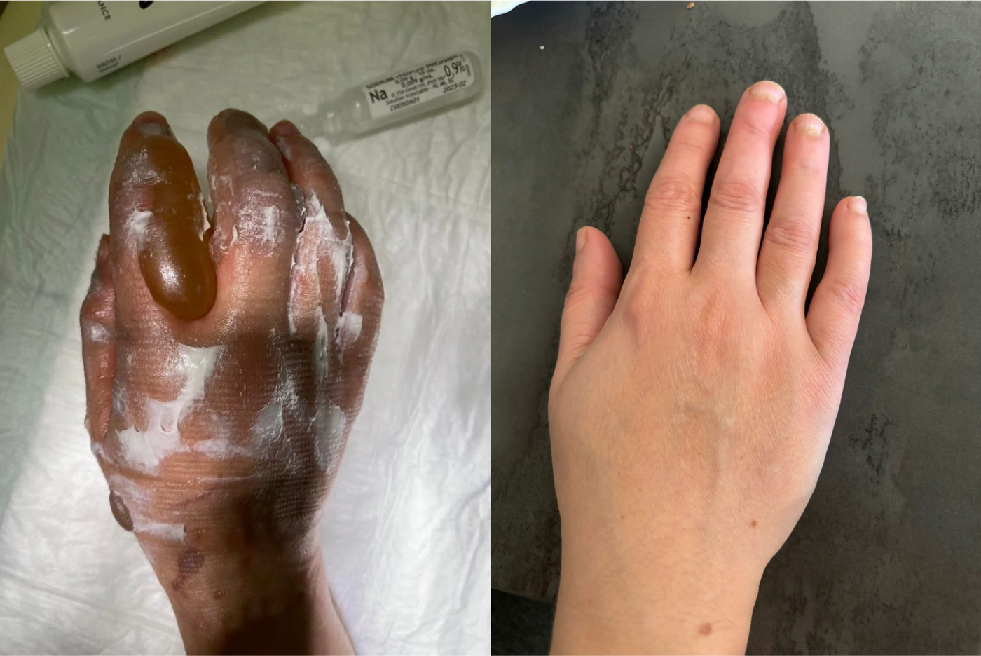 Main d'Amelle avant et après traitement à l'huile de lentisque — Lentis'Care